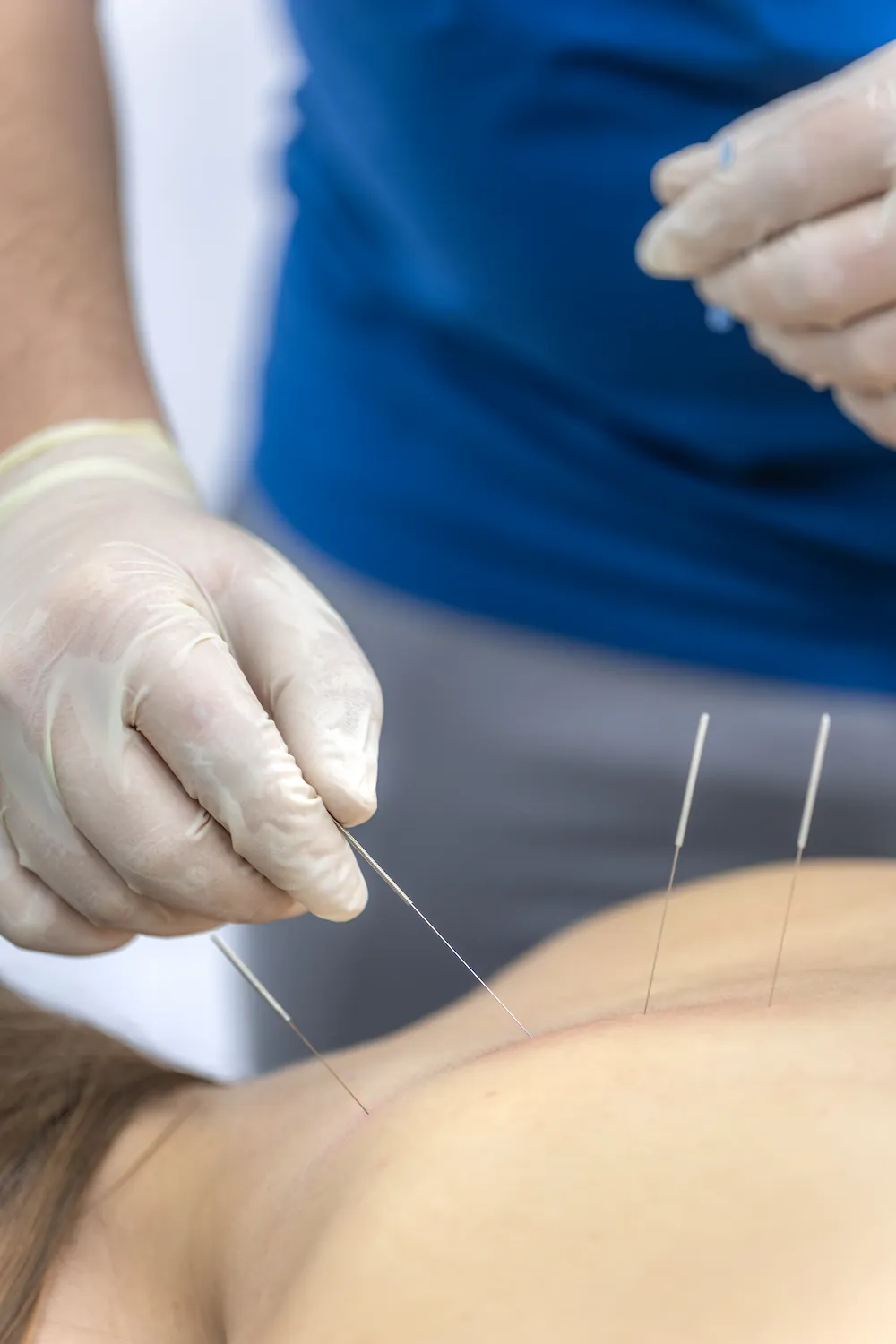 Acupuncture